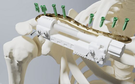 Sicherer operieren dank 3D-Planung