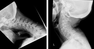 Röntgenbilder einer Patientin mit dem «Dropped Head Syndrom».