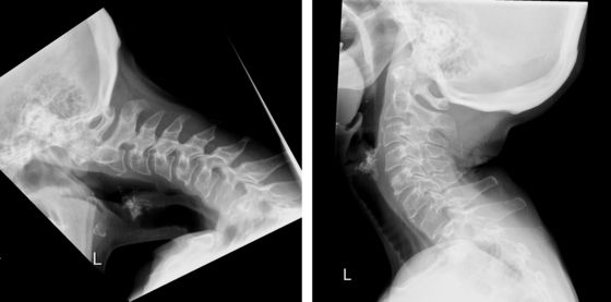 Röntgenbilder einer Patientin mit dem «Dropped Head Syndrom».
